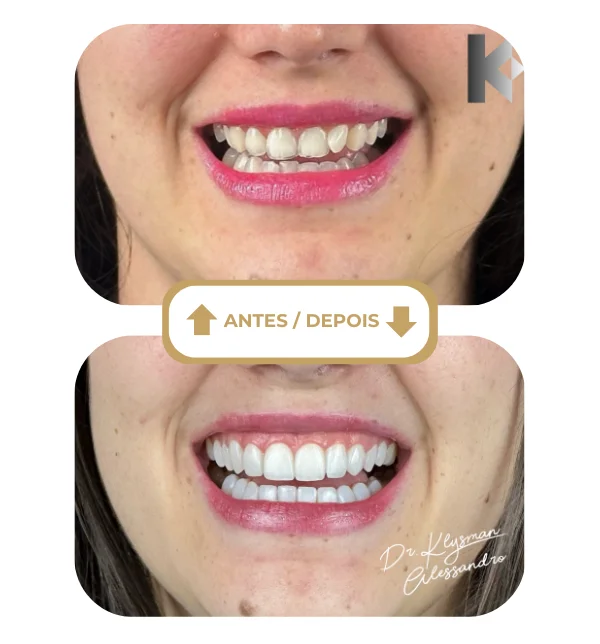 Resultado antes e depois 1