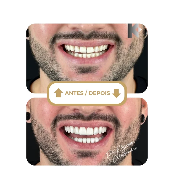Resultado antes e depois 10
