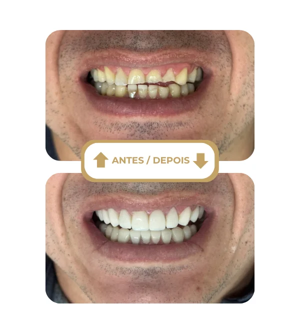 Resultado antes e depois 3