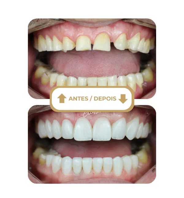 Resultado antes e depois 5