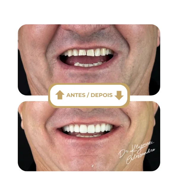 Resultado antes e depois 6